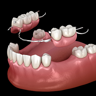 Illustration of a partial denture replacing several teeth along an arch