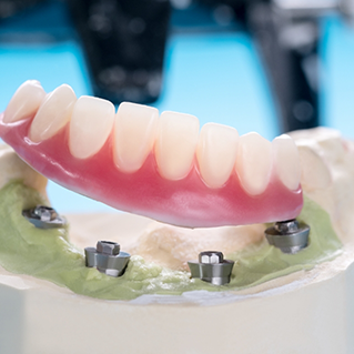 Model of an implant denture in a dental lab