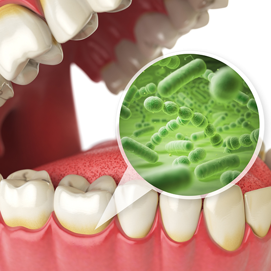 Illustration of an infected mouth that needs gum disease treatment