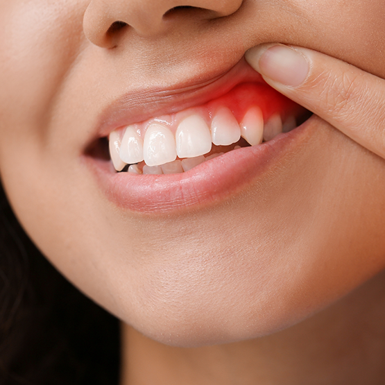 Close up of a person pointing to a red spot in their gums