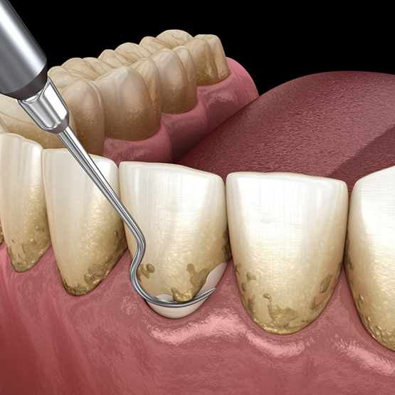 Illustration of a dental scaler clearing tartar buildup from the gums and teeth