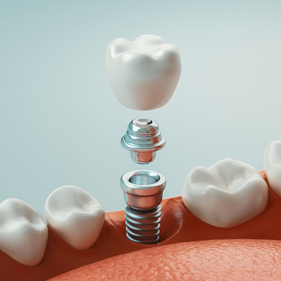 Illustration of a dental implant replacing a missing lower tooth