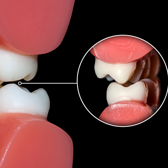 Illustration of upper and lower teeth grinding together