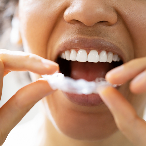 Person placing a white nightguard over their teeth