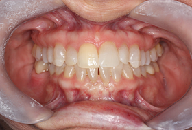 Close up of a mouth with whiter teeth