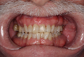 Close up of a man with much whiter teeth