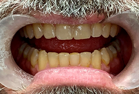 Close up of a man with newly restored and straightened teeth