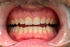 Close up of a mouth after closing the gap between the two front teeth