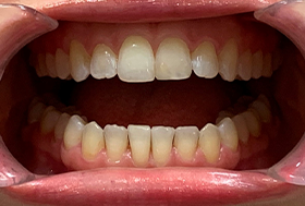 Close up of a mouth after aligning crooked teeth