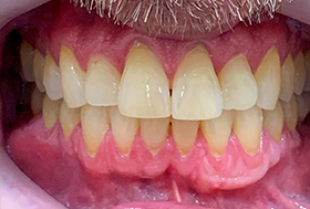 Mouth after whitening the teeth