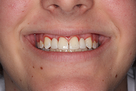 Person smiling with a whole row of upper teeth