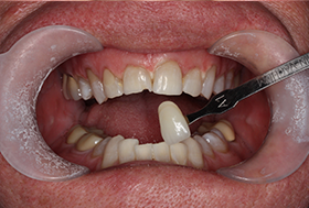 Dentist holding a veneer in front of a mouth with whiter teeth