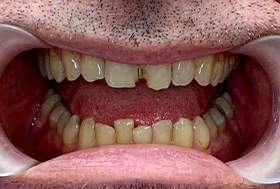 Close up of a man with chipped and slightly misaligned teeth