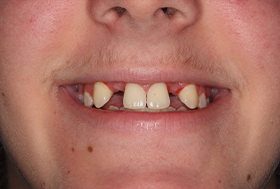 Person smiling with two missing upper teeth