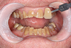 Dentist holding a veneer in front of a mouth with yellowed teeth