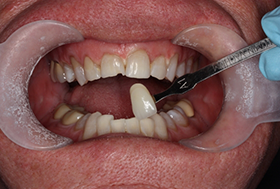 Dentist holding a veneer in front of a mouth with whiter teeth