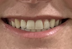 Close up of a mouth with well aligned teeth