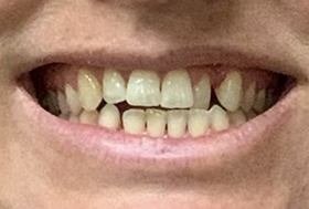 Close up of a mouth with slightly misaligned teeth