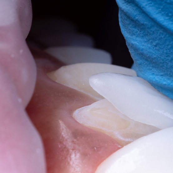 Close up of a veneer being placed over a tooth