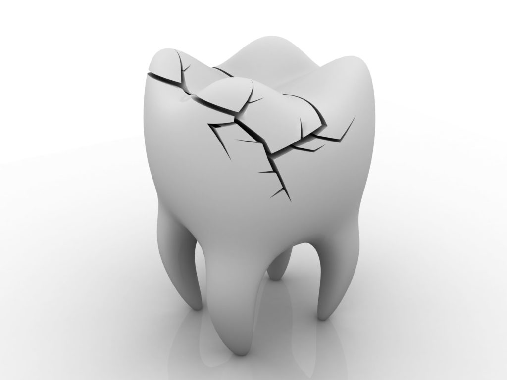 Dentist for Cracked Tooth Syndrome in Tallahassee Boyd Dental Associates